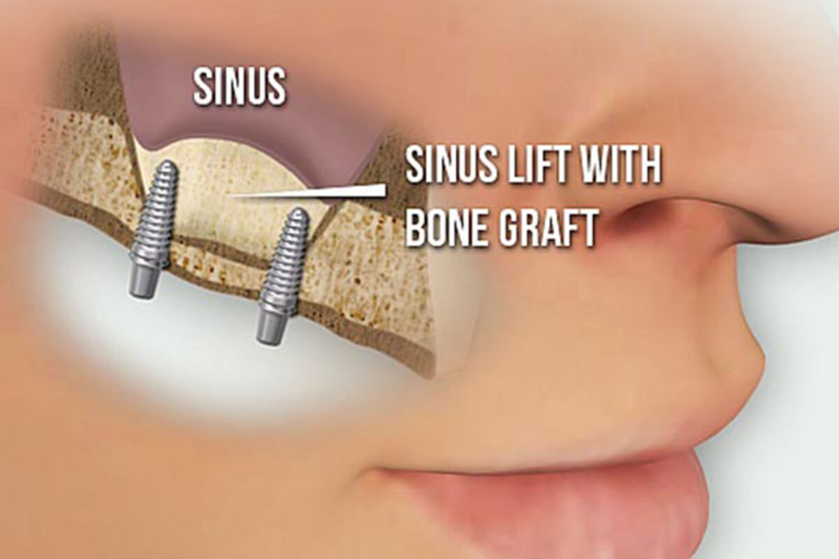 Bone Augmentation & Sinus Lifts