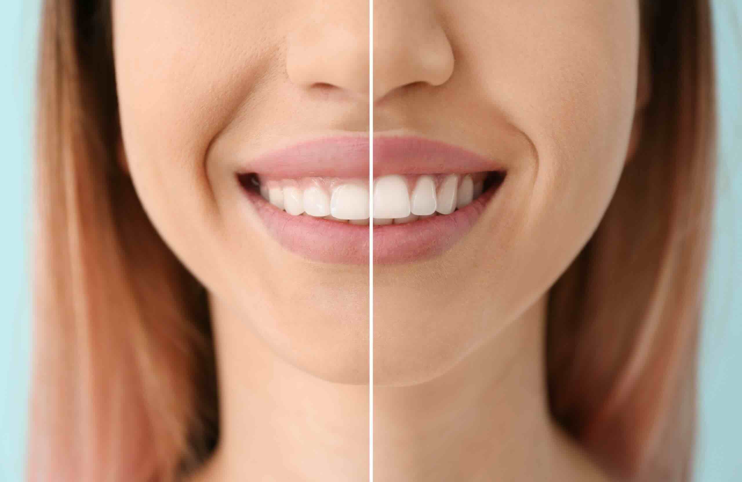Cosmetic Gum Surgery